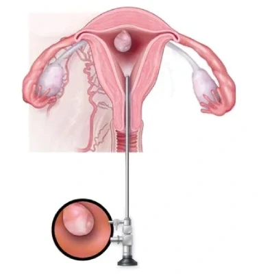 hysteroscopicmyomectomy.webp