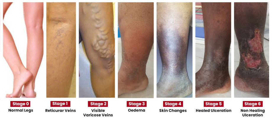 stagesofvaricoseveins1.jpg