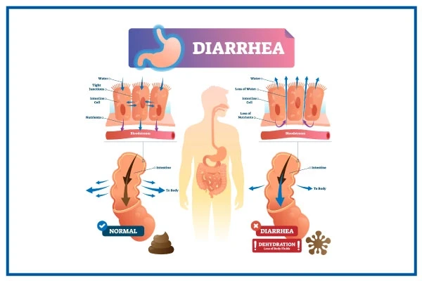 diarrhea.webp