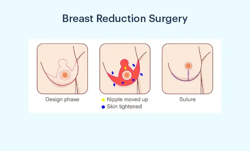 breastreduction.webp