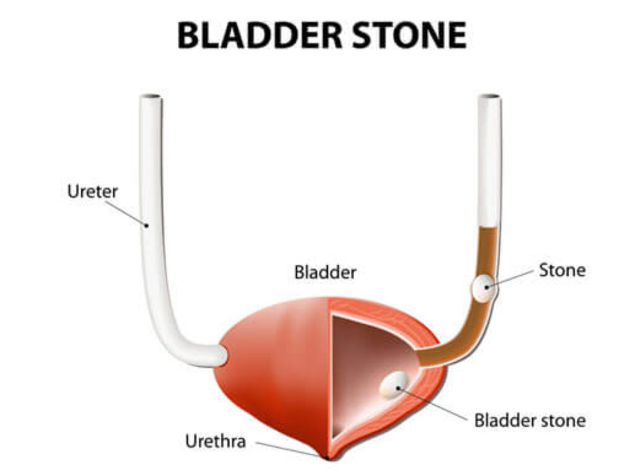 bladderstones1200x900.jpg