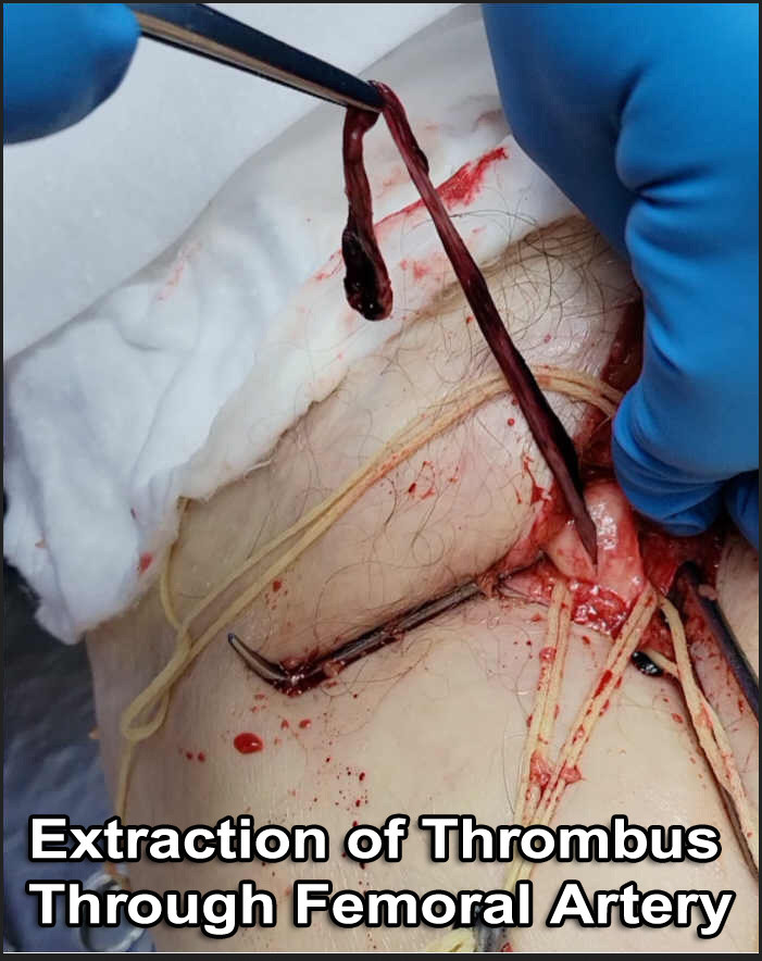 thrombusslidea.jpg