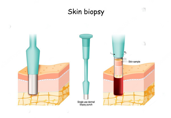 skinbiopsy.jpg