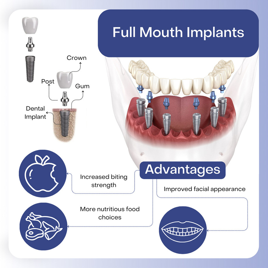 fullmouthdentalimplants.jpg