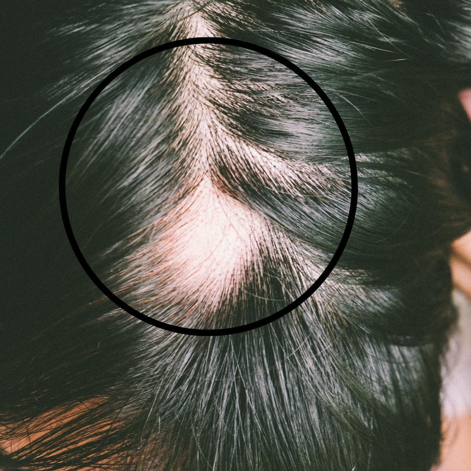 alopeciaareata.jpg