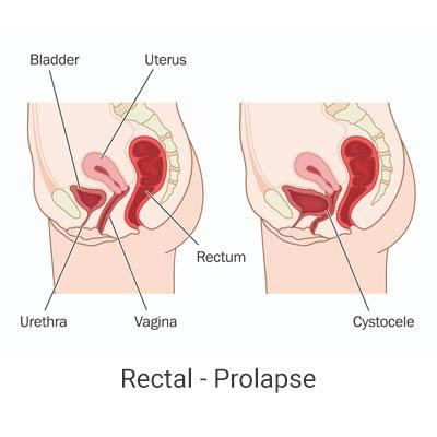 urogynecologyclinicchennairectalprolapse.jpg