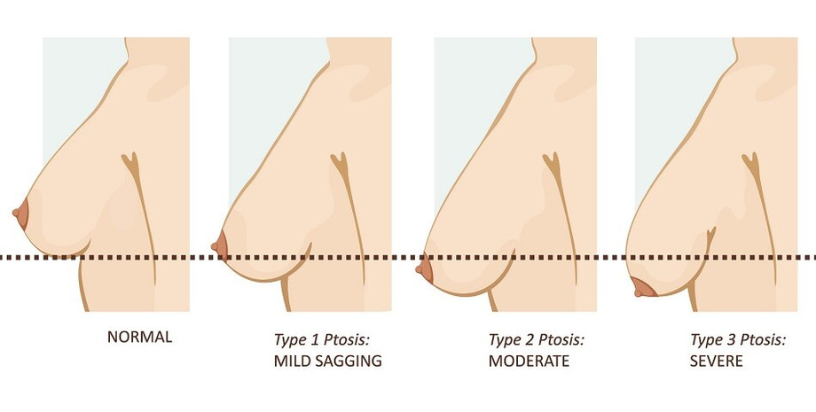 gradesofbreastptosisandsagging1.jpg