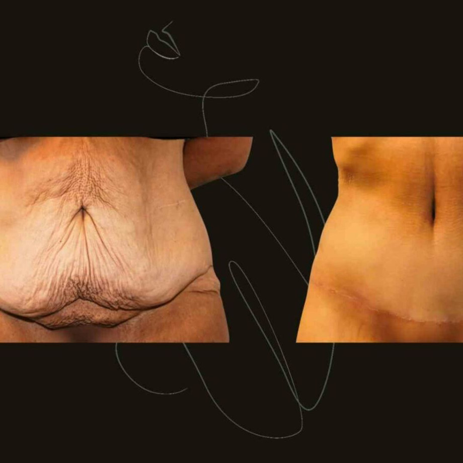 gynecomastiasurgerynyc.jpg