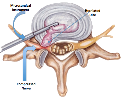 microdiscectomy.png