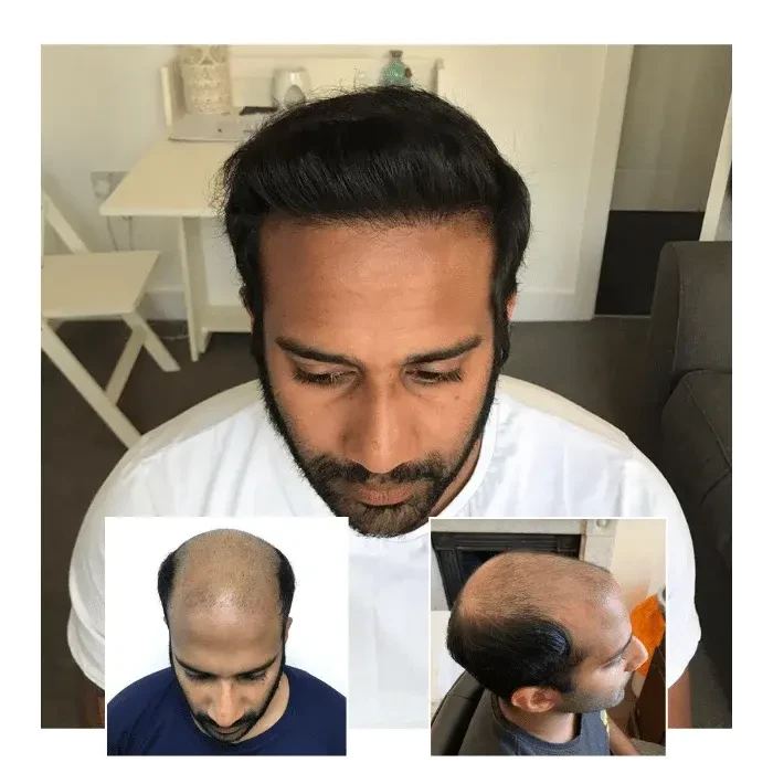 beforeafterhairtransplanttunbridgewells02.webp