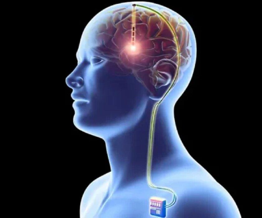 deepbrainstimulationsurgeryinmumbaidrmanishbaldia.jpg
