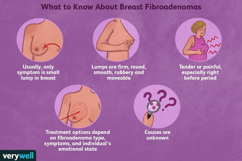 breastfibroadenomatreatments4300199ac75ed1f27c4bffa551937bea5cbf9d.jpg