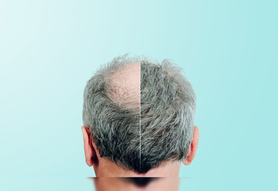 hairtransplant1.jpg
