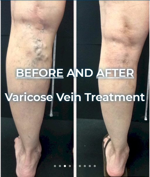 beforeandaftervaricoseveintreatment.jpg