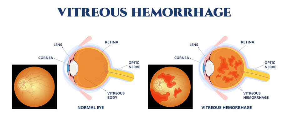 vitreoushemorrhage1.jpg