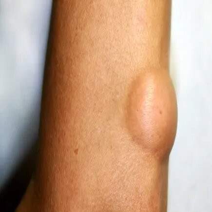 lipoma.jpg