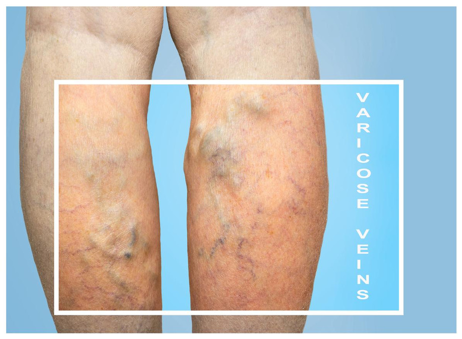 varicoseveins.jpg