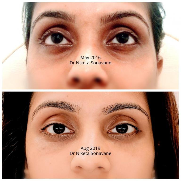 darkcirclestreatmentinmumbaiundereyefillersinmumbaidermalfillersinmumbaibeforeafter3768x768.jpg
