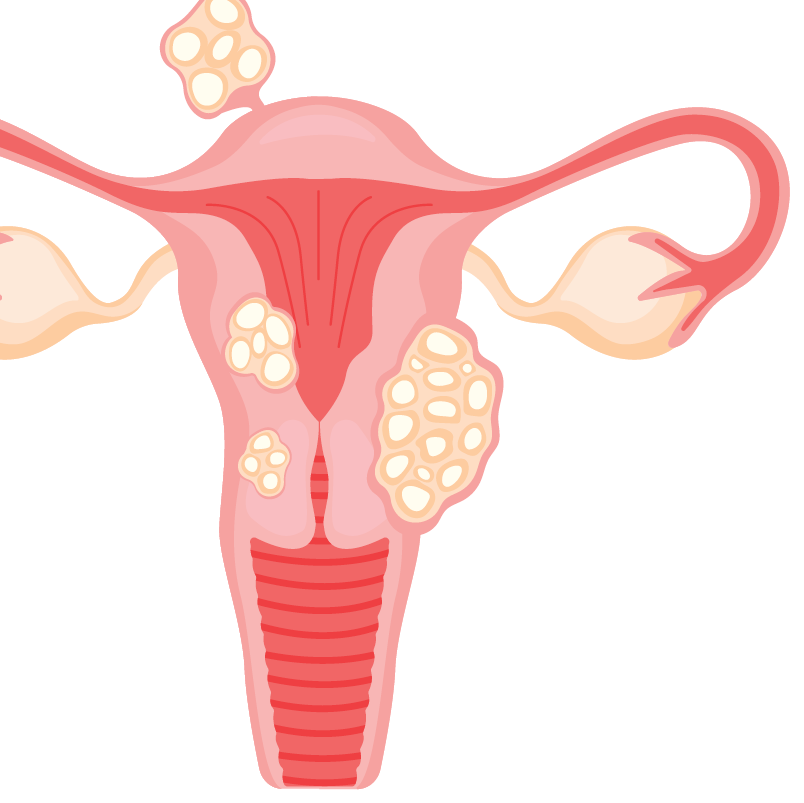 fibroid.png