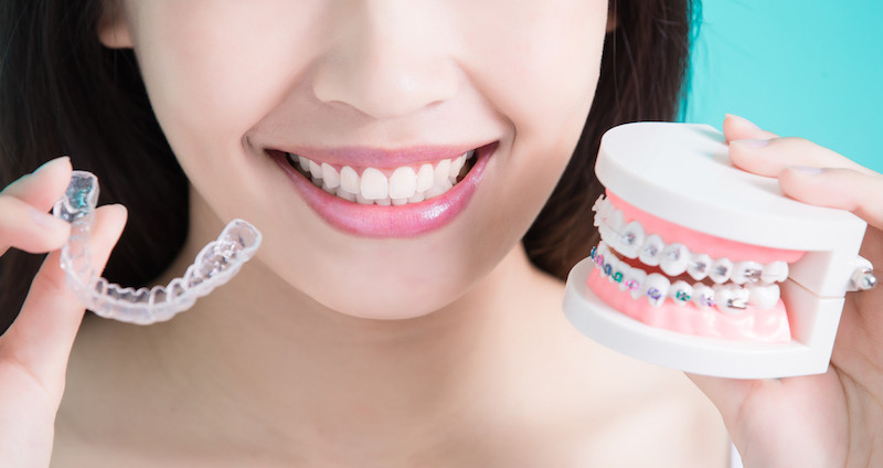 braces_and_clear_aligners.jpg