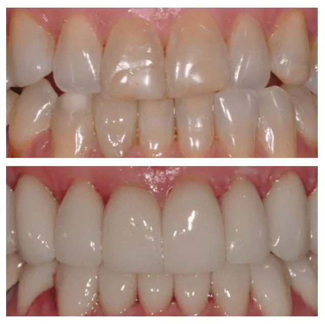 laurelsmilesdentalcareafterbefore11682b0a3ec7814.jpeg
