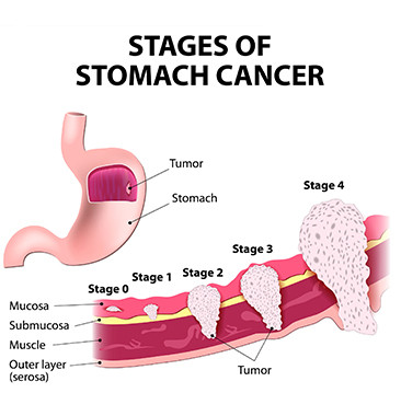 stagesofstomachcancer.jpg