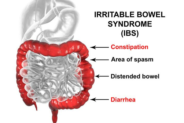 irritablebowelsyndromeibs.jpg