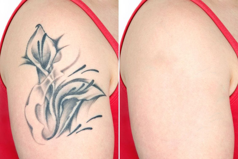 lasertattooremoval.jpg