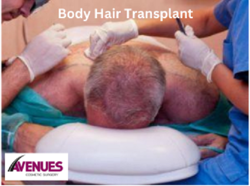 bodyhairtransplant.png