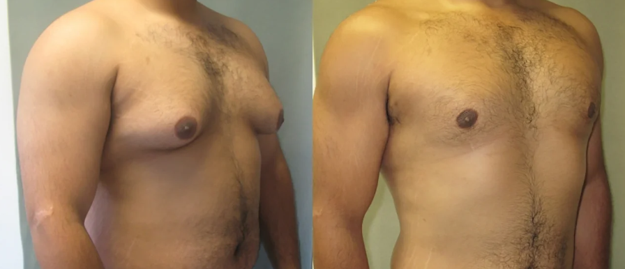 blog_banner_earlysignsofgynecomastia.png