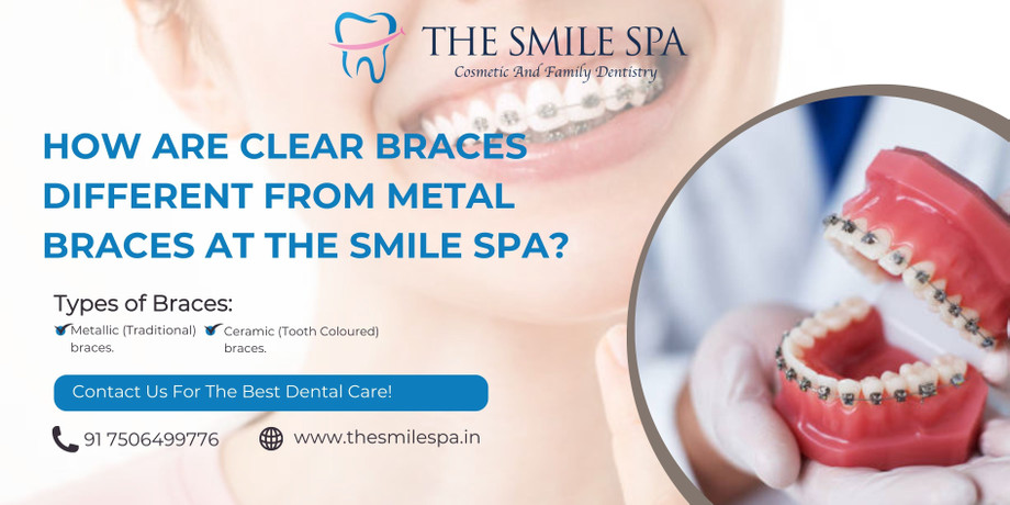 howareclearbracesdifferentfrommetalbracesatthesmilespa.jpg