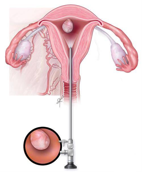 hysteroscopicmyomaresection.jpg