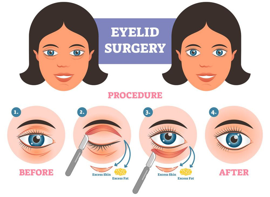 eyelidsurgeries.jpg