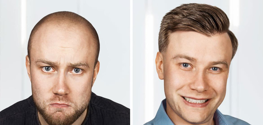 hairtransplantsuccessrate.jpg