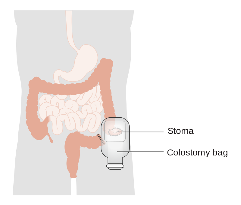 ostomyorstomacare.png