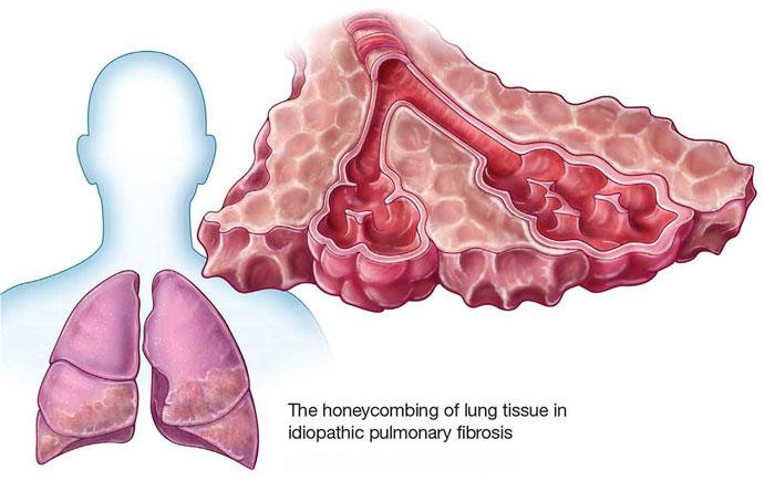 idiopathicpulmonaryfibrosislungspecialistinmumbai.jpg