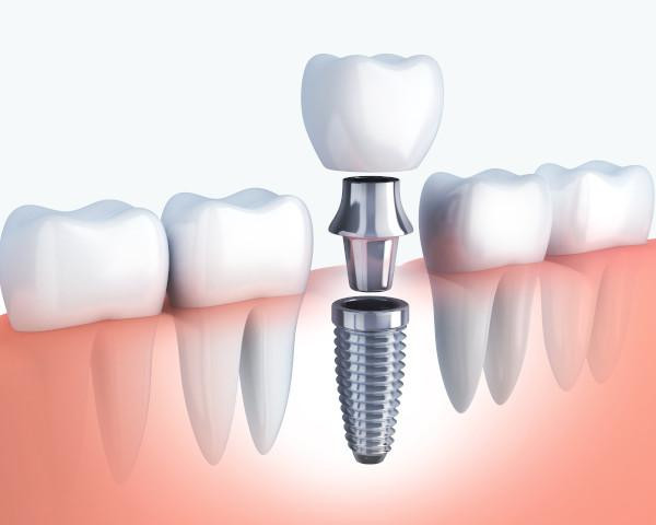 dental_implant.jpg