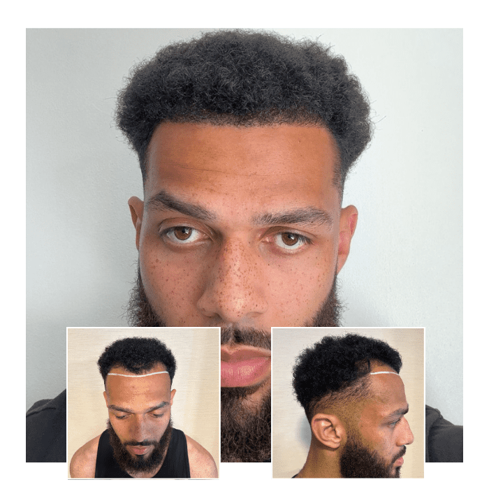 imgi_70_beforeafterhairtransplantharleystreetlondon06.png