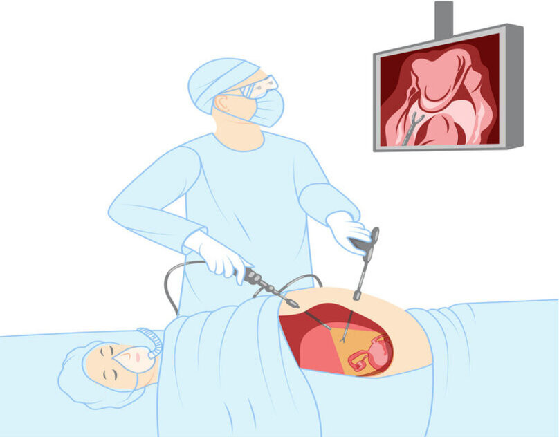 laparoscopykeyholesurgerydoctorwithapatientvector43204495111.jpg