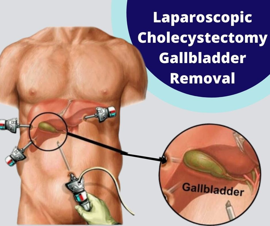 laparoscopiccholecystectomytreatmentinpune.jpg