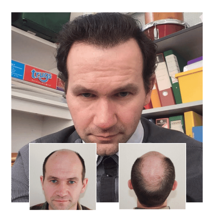 imgi_59_beforeafterhairtransplantharleystreetlondon07.png