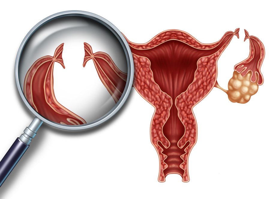 what_are_the_advantages_of_laser_tubal_ligation_637435410387231344.png