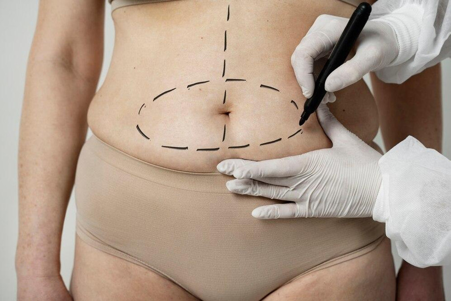 liposuction.jpg